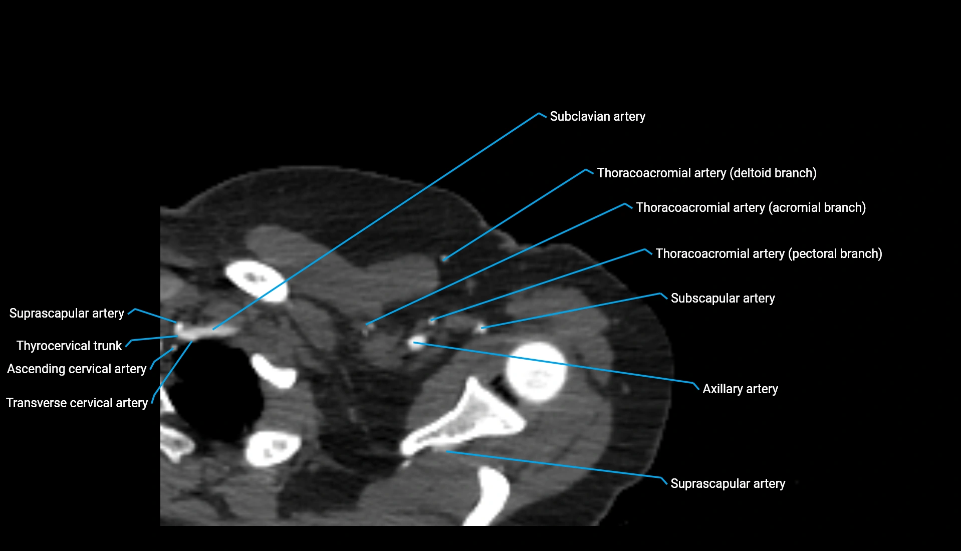CTA upper limb axial cross sectional anatomy labelled image 332 (1).webp